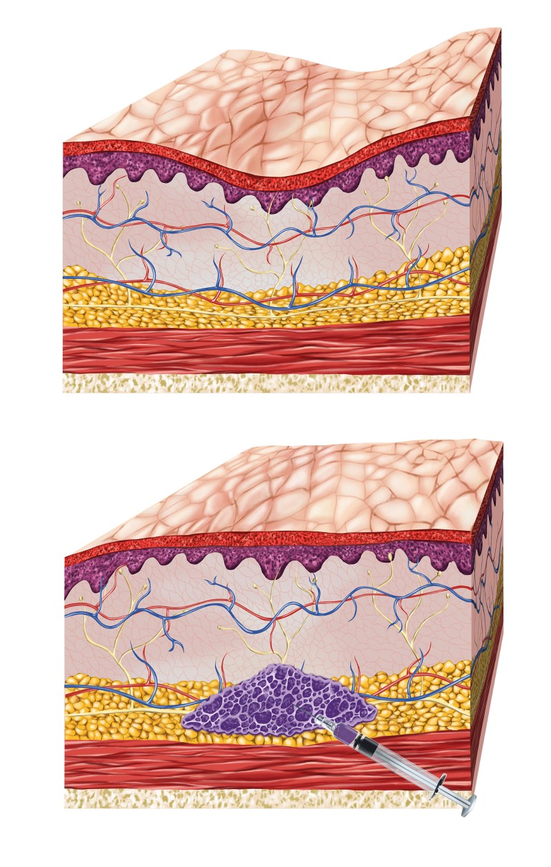 SkinBlock_VolumeLoss1+4(Col)FA
